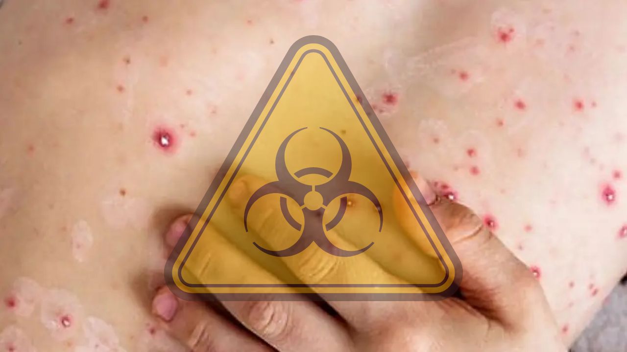 OMS declara emergencia mundial por Mpox en África (video)